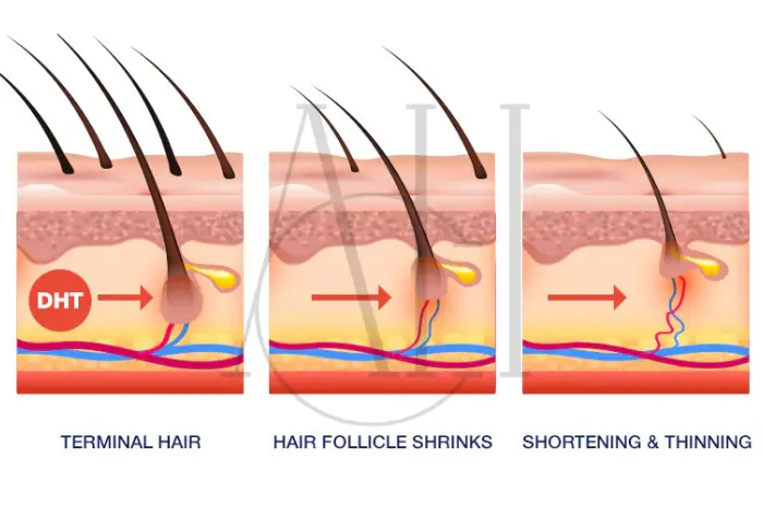 I bloccanti del DHT spiegano come funzionano e la loro efficacia per la perdita dei capelli