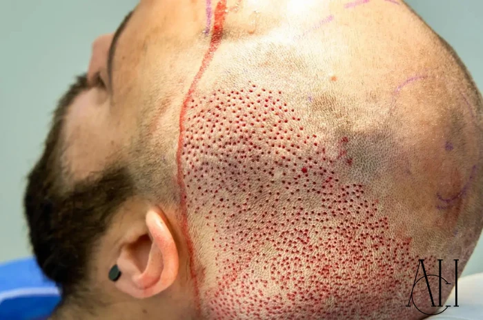 body hair to head transplant