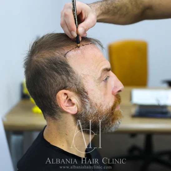 Transplanti DHI në Shqipëri - Udhëzuesi juaj për Restaurimin e Flokëve