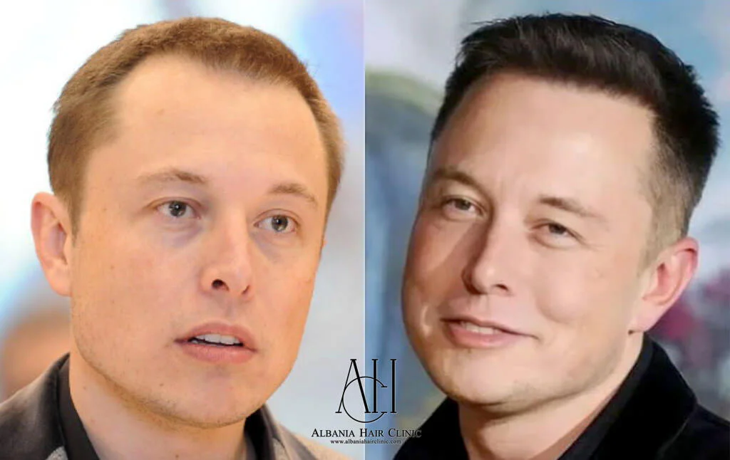 Elon Musk Hair Transplant