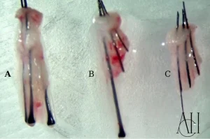 5000-innesti-trapianto-capelli-turchia