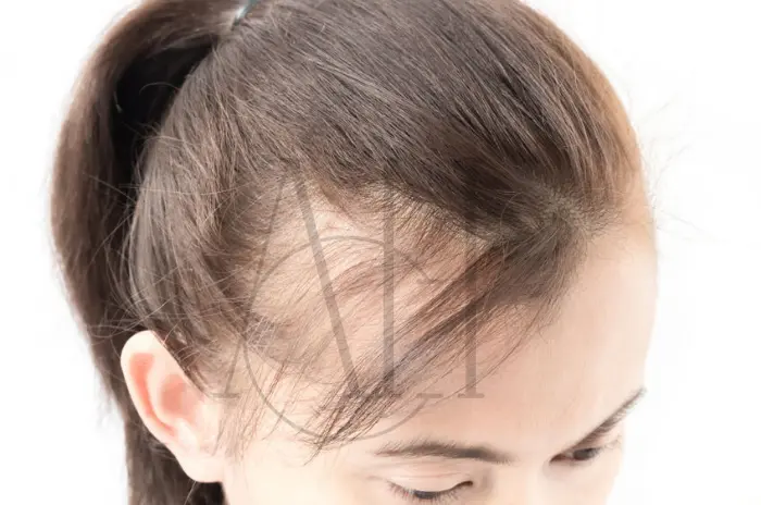 spironolactone for PCOS hair loss