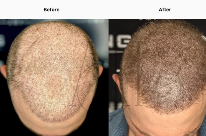 scalp micropigmentation