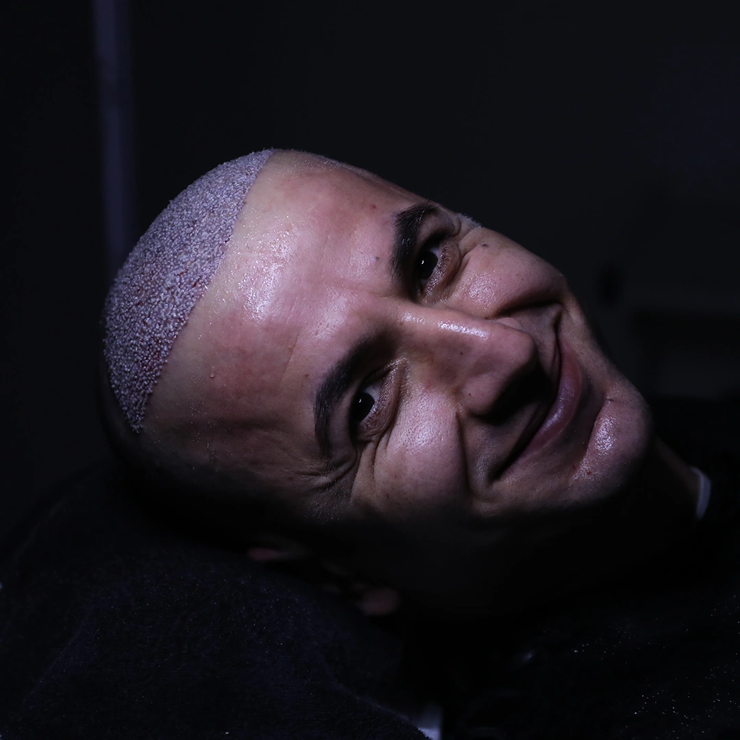 hair-transplant-in-italy