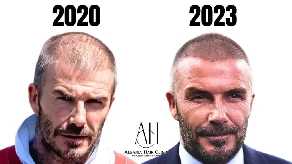 hair translpant of david beckham