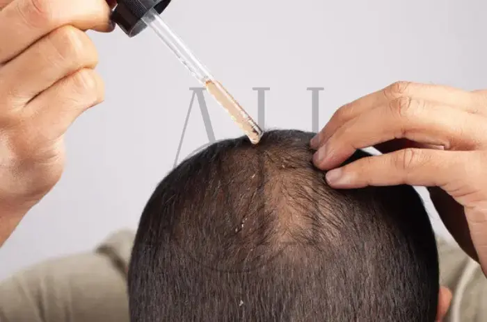 dermatologist hair loss treatment