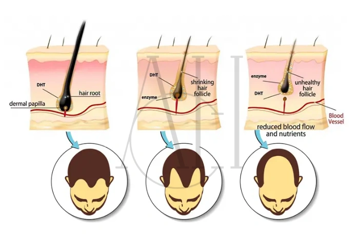 DHT (Dihydrotestosterone) Hair Loss Causes Effects and How to Manage It