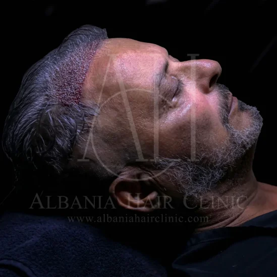 Udhëzime për kujdesin e mëpasshëm të transplantit të flokëve: Si të merrni rezultate optimale