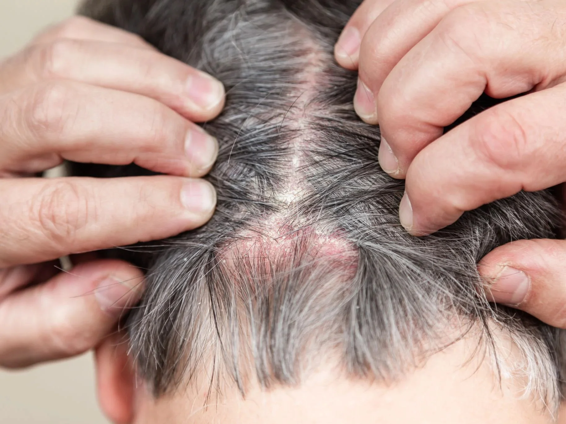 Prurito al cuoio capelluto e perdita di capelli: cause e trattamenti efficaci