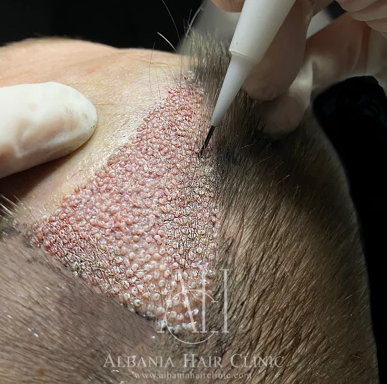 Sapphire FUE vs DHI: Which Method is Right for You?