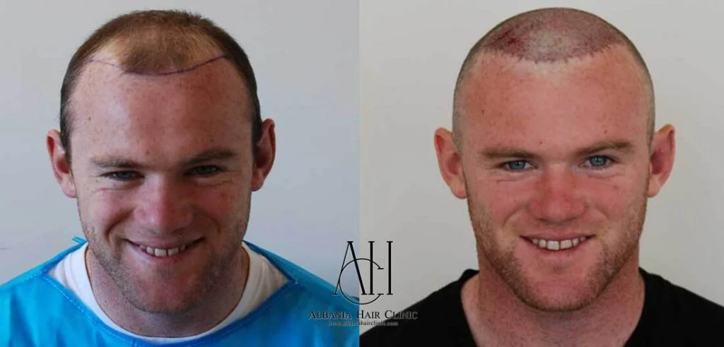 wayne rooney Hair Transplant