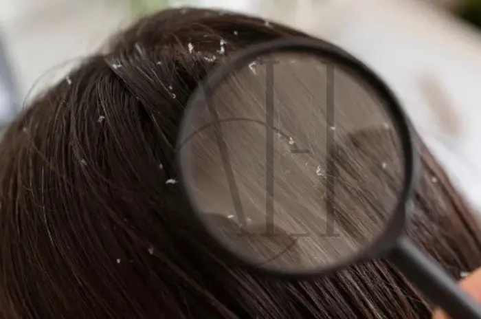 dandruff hair women