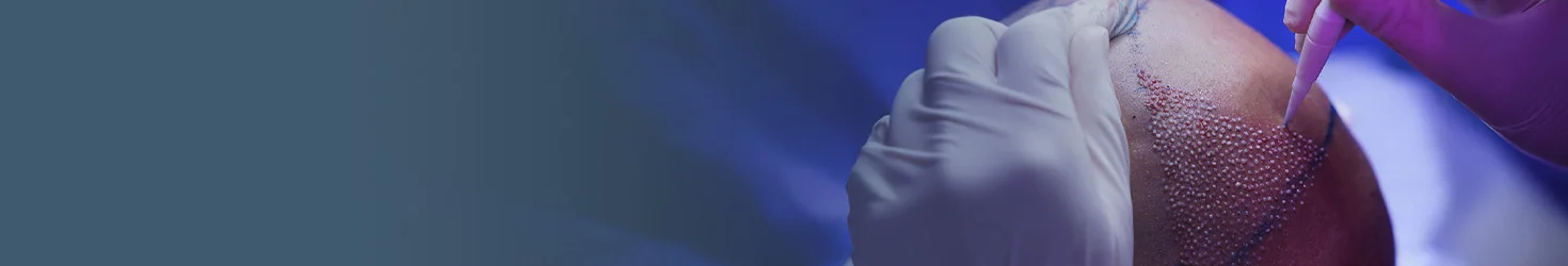 DHI Hair Transplant in Albania