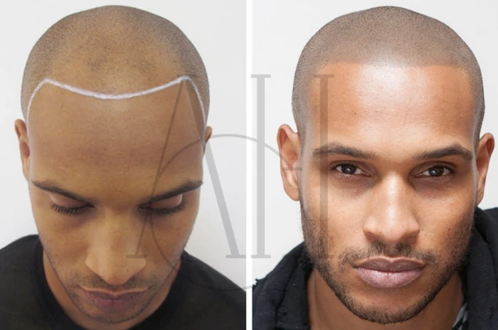 Hair Tattooing for Men: Pros and Cons