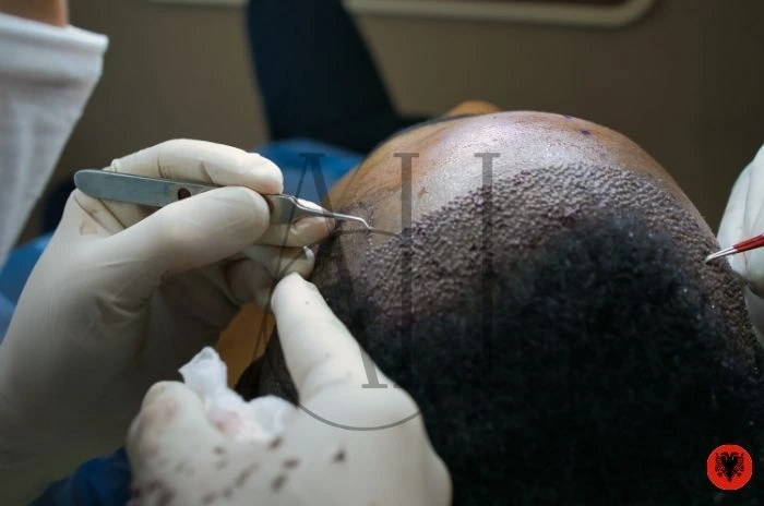 Hair Transplant Packages in Albania