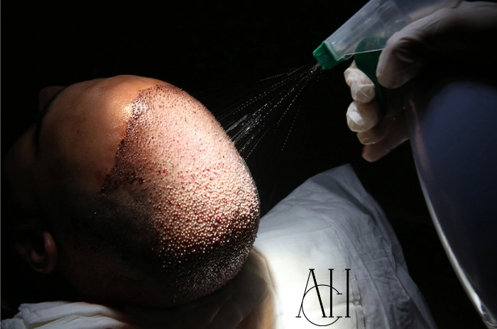 trapianto-di-capelli-albania-tirana