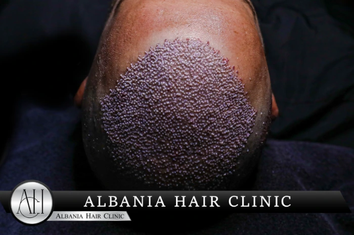 Quanto dura un trapianto di capelli