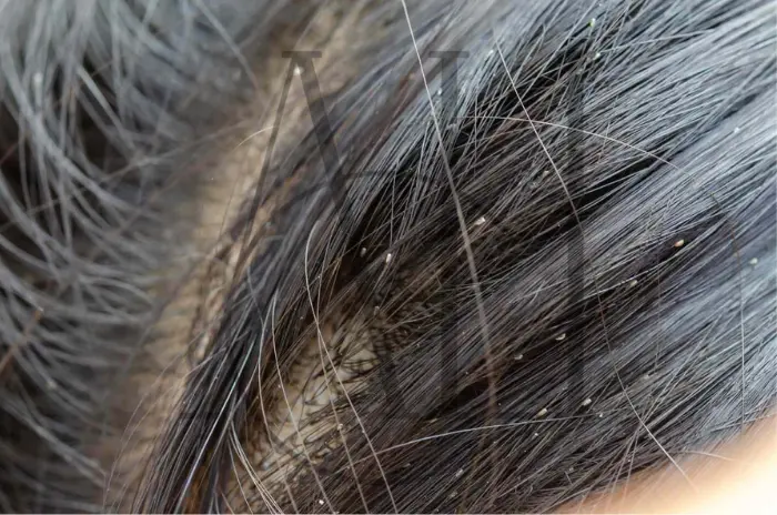 Come Sono Fatti i Pidocchi? Sintomi e Consigli per Rimuoverli