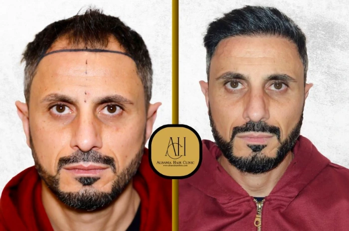 how long do hair transplants last​