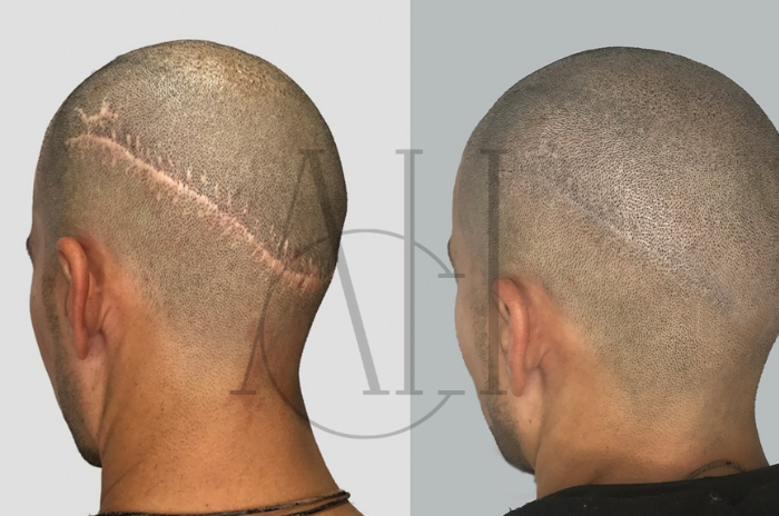 before scalp micropigmentation