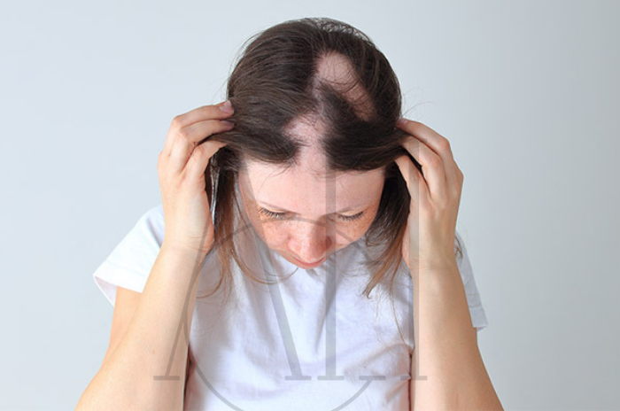 Comprensione dei segni della perdita di capelli LPP