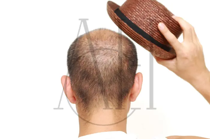 Does Wearing a Hat Cause Hair Loss Myths and Prevention Tips