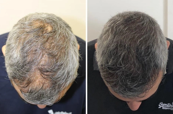 hair loss gene therapy