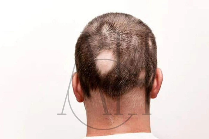Traction Alopecia Guide to Prevention and Treatment