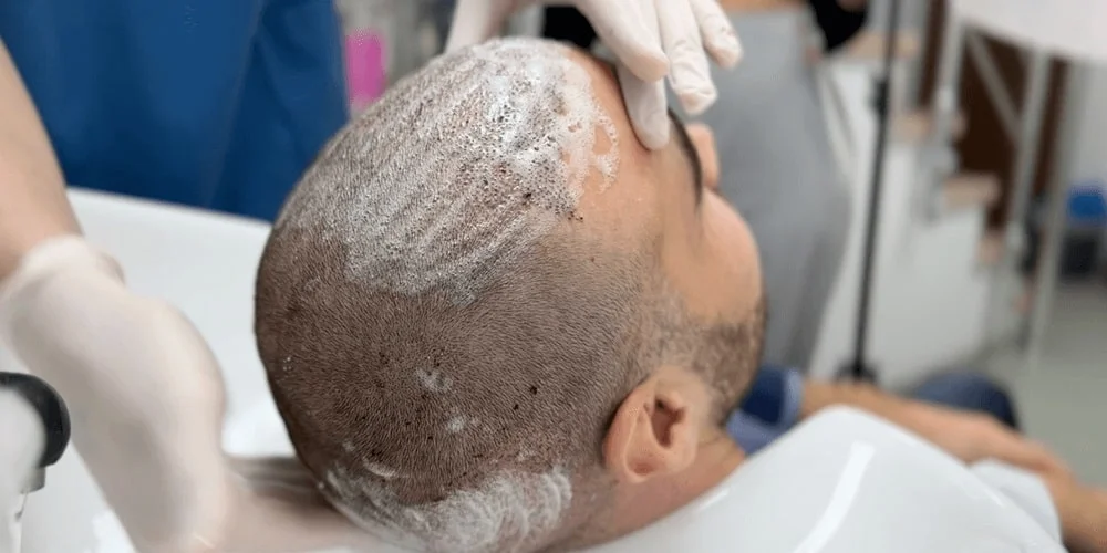 Hair Transplant Recovery in Albania: What to Expect After Surgery