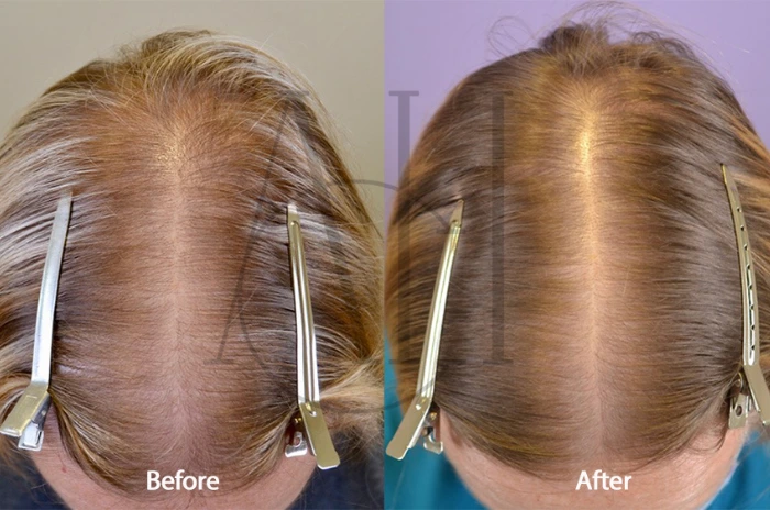 Hair loss treatment for women