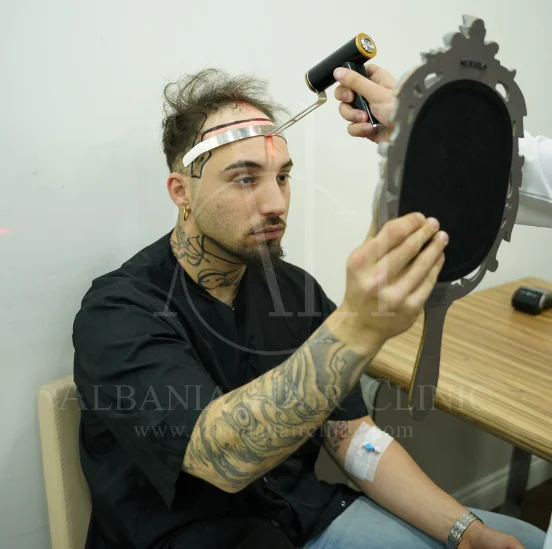 Shërimi i vendit të donatorëve të transplantit të flokëve