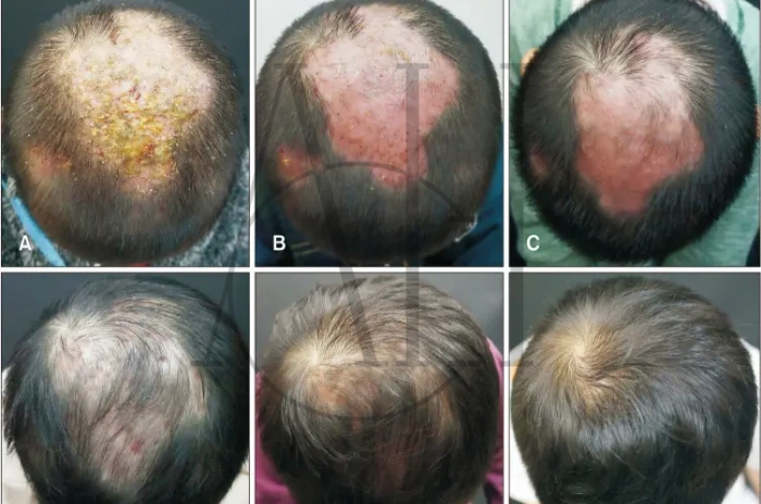 ringworm hair loss