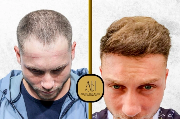 Hair Transplants Facts vs Fiction Clearing the Confusion