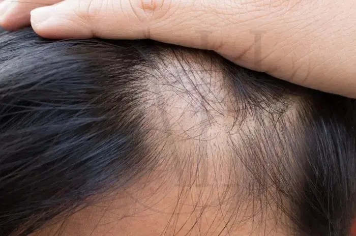 Scarring Alopecia Symptoms and Solutions