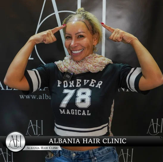 Trapianto di capelli per donne: Ridare fiducia e bellezza