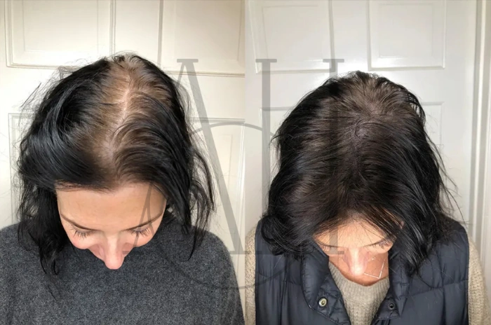 lupus and hair loss treatment