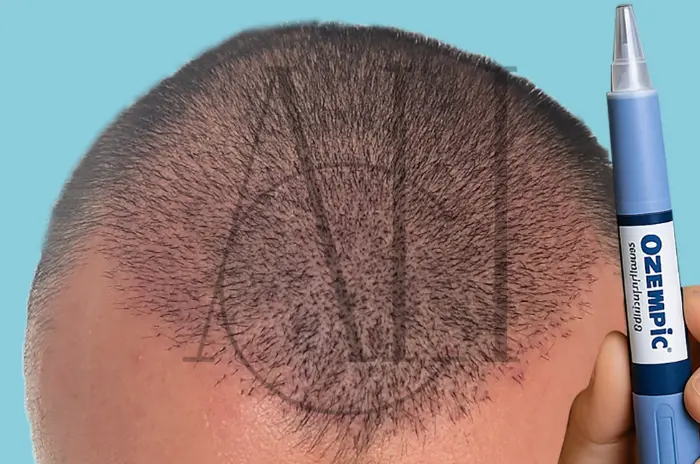 A shkakton Ozempic rënie të flokëve?