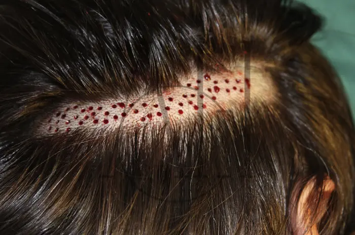 Scalp Biopsy Procedure Steps Risks and Benefits Explained