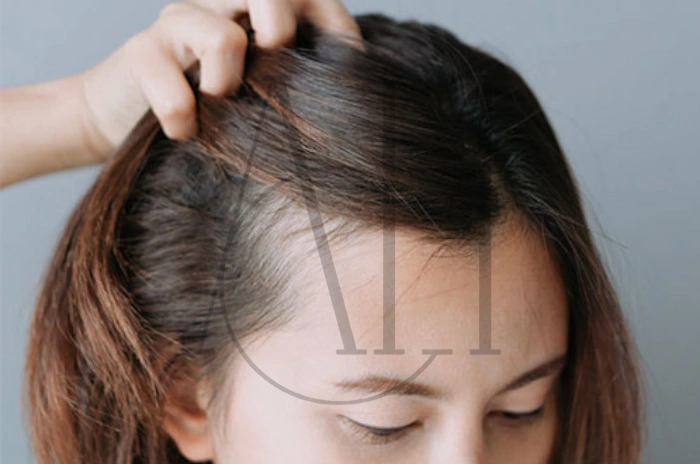 Postpartum Hair Loss Causes and Management