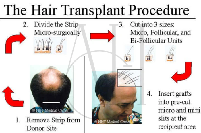 Male pattern hair loss treatment