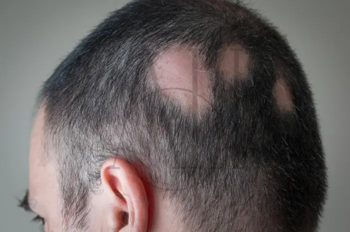 Guida alla caduta dei capelli dell'alopecia areata: cause