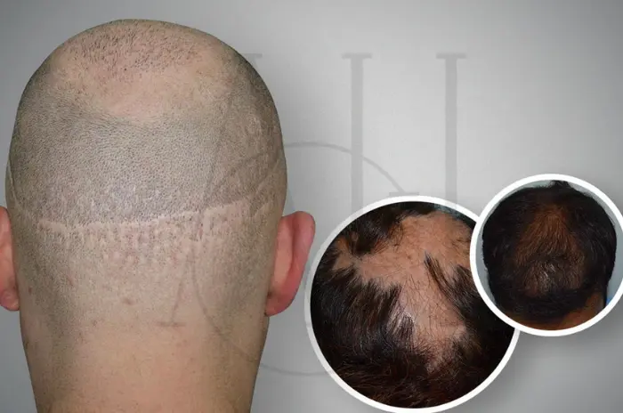 Scarring Alopecia Symptoms and Solutions
