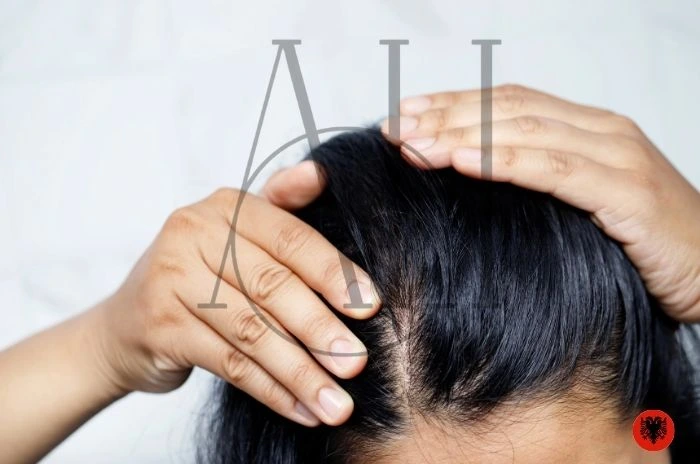 Hair Transplant Women in Albania