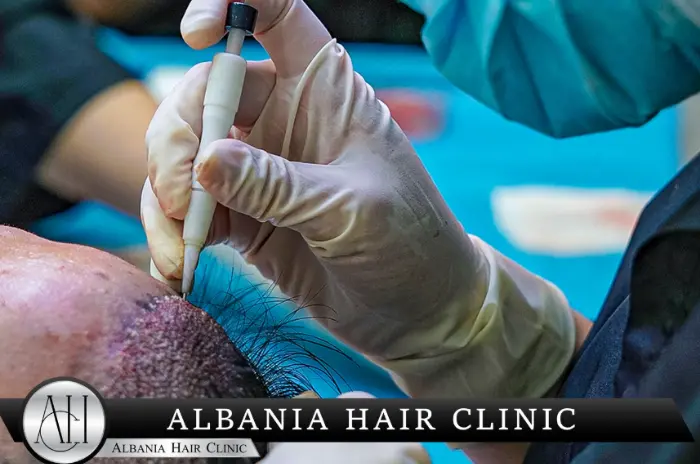 Aspirin and Hair Transplant