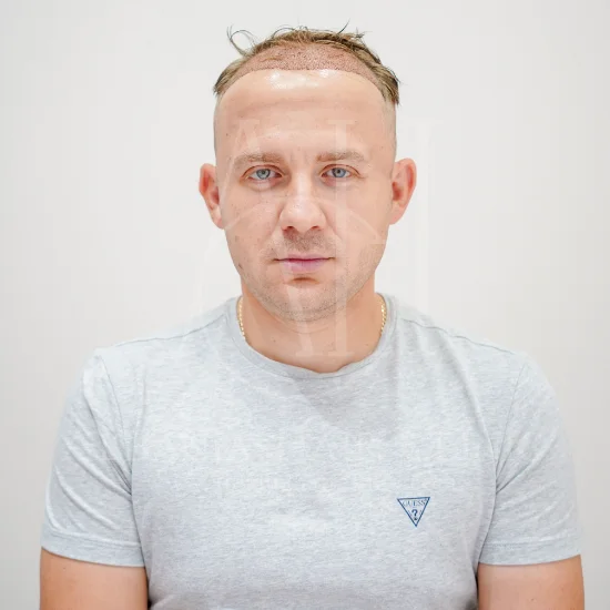 Trapianto di capelli senza aghi - Il futuro della ricostruzione dei capelli