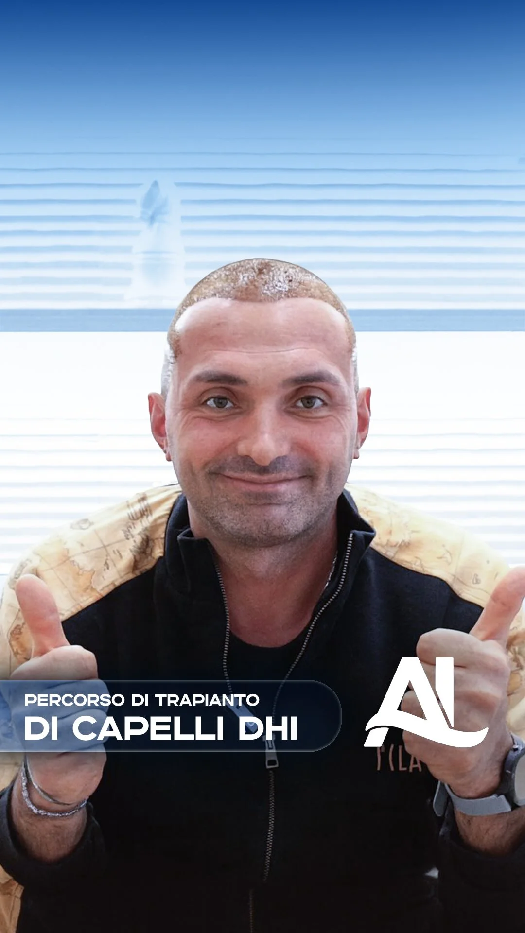 trapianto di capellidhi-insta