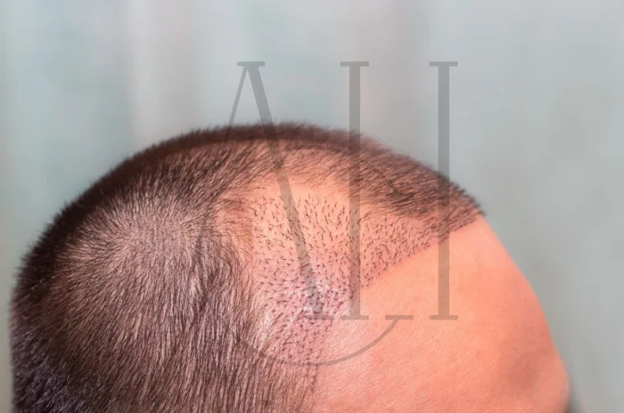 When to Return to Work After Hair Transplant