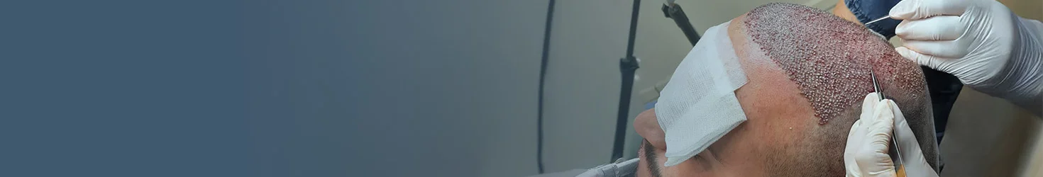 Costo Trapianto Capelli in Albania