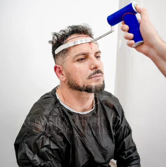 Linee guida per l'esposizione al sole del trapianto di capelli