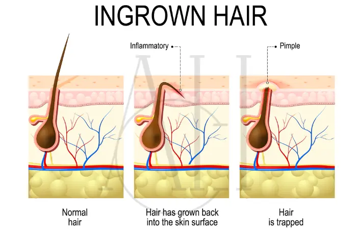 Ingrown Hair vs Herpes Symptoms Causes and Treatment Options